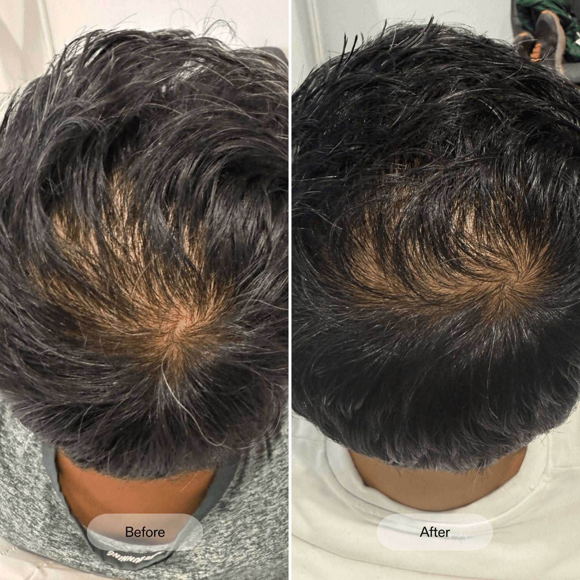 PRP Hair Growth Result Before-After